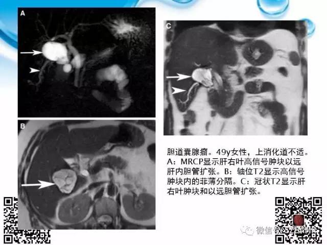 【PPT】胆道狭窄和胆道肿块样病变