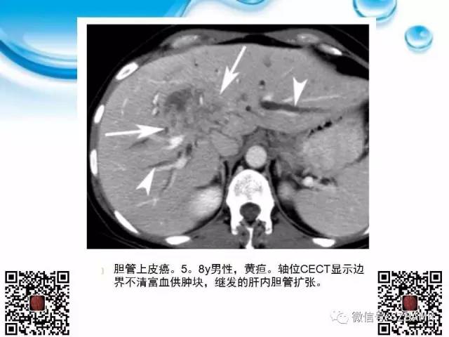 【PPT】胆道狭窄和胆道肿块样病变