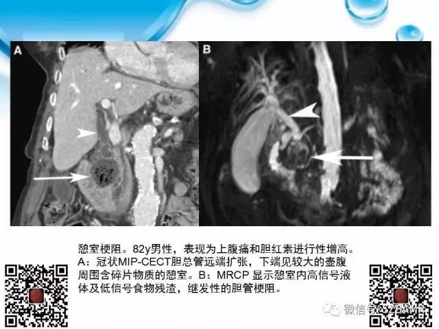 【PPT】胆道狭窄和胆道肿块样病变