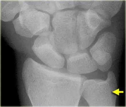 腕关节骨折的影像、分型及治疗 腕关节骨折的影像、分型及治疗