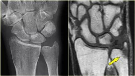 腕关节骨折的影像、分型及治疗 腕关节骨折的影像、分型及治疗