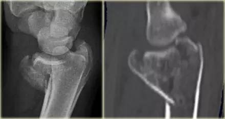 腕关节骨折的影像、分型及治疗 腕关节骨折的影像、分型及治疗