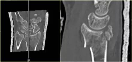 腕关节骨折的影像、分型及治疗 腕关节骨折的影像、分型及治疗
