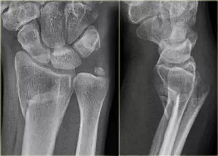 腕关节骨折的影像、分型及治疗 腕关节骨折的影像、分型及治疗