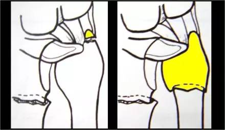 腕关节骨折的影像、分型及治疗 腕关节骨折的影像、分型及治疗