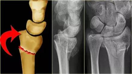 腕关节骨折的影像、分型及治疗 腕关节骨折的影像、分型及治疗