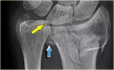 腕关节骨折的影像、分型及治疗 腕关节骨折的影像、分型及治疗