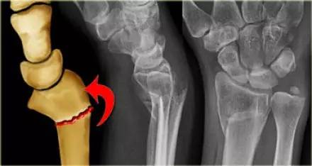 腕关节骨折的影像、分型及治疗 腕关节骨折的影像、分型及治疗