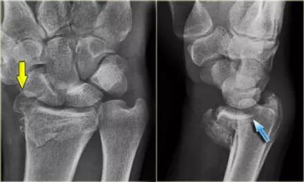腕关节骨折的影像、分型及治疗 腕关节骨折的影像、分型及治疗