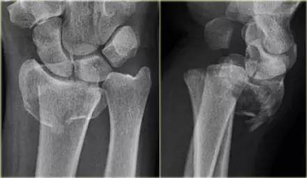 腕关节骨折的影像、分型及治疗 腕关节骨折的影像、分型及治疗