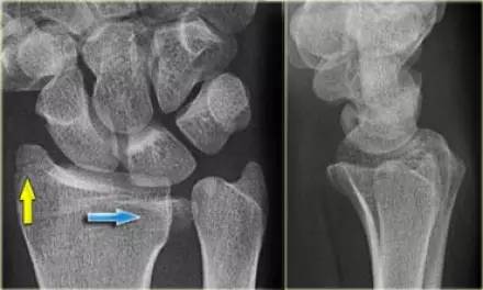 腕关节骨折的影像、分型及治疗 腕关节骨折的影像、分型及治疗