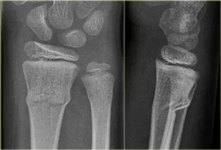 腕关节骨折的影像、分型及治疗 腕关节骨折的影像、分型及治疗