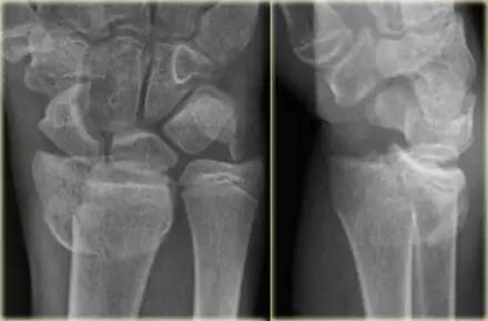 腕关节骨折的影像、分型及治疗 腕关节骨折的影像、分型及治疗