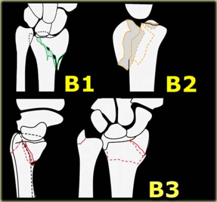 腕关节骨折的影像、分型及治疗 腕关节骨折的影像、分型及治疗