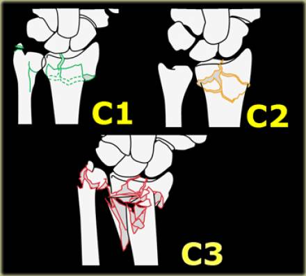 腕关节骨折的影像、分型及治疗 腕关节骨折的影像、分型及治疗