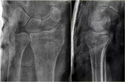 腕关节骨折的影像、分型及治疗 腕关节骨折的影像、分型及治疗