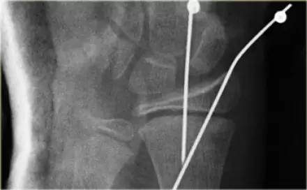 腕关节骨折的影像、分型及治疗 腕关节骨折的影像、分型及治疗
