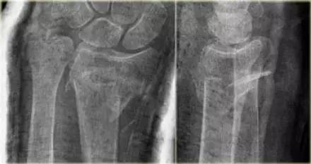 腕关节骨折的影像、分型及治疗 腕关节骨折的影像、分型及治疗