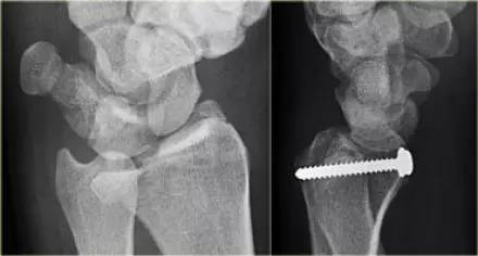 腕关节骨折的影像、分型及治疗 腕关节骨折的影像、分型及治疗