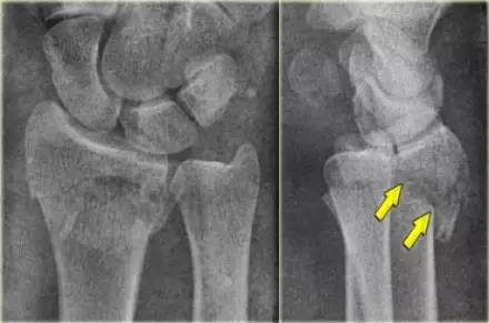 腕关节骨折的影像、分型及治疗 腕关节骨折的影像、分型及治疗