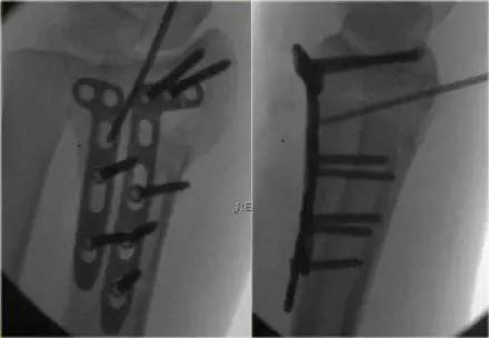 腕关节骨折的影像、分型及治疗 腕关节骨折的影像、分型及治疗