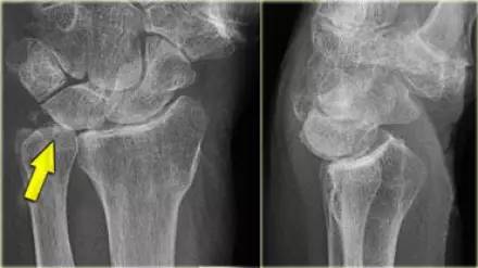腕关节骨折的影像、分型及治疗 腕关节骨折的影像、分型及治疗