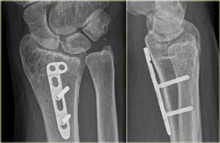 腕关节骨折的影像、分型及治疗 腕关节骨折的影像、分型及治疗