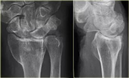 腕关节骨折的影像、分型及治疗 腕关节骨折的影像、分型及治疗