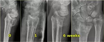 腕关节骨折的影像、分型及治疗 腕关节骨折的影像、分型及治疗