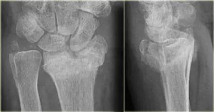 腕关节骨折的影像、分型及治疗 腕关节骨折的影像、分型及治疗