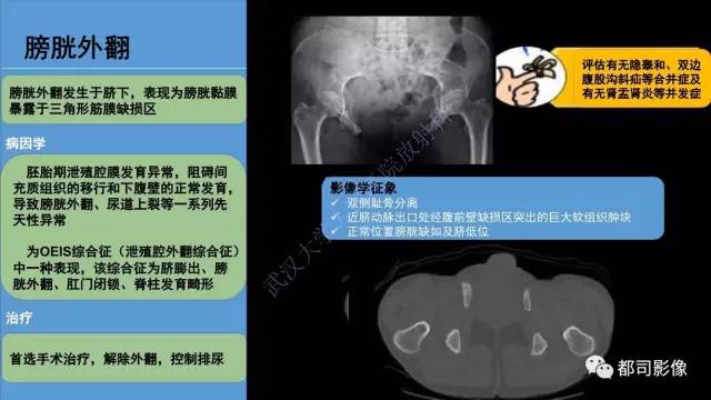 【PPT】腹壁病变-不只是腹壁疝