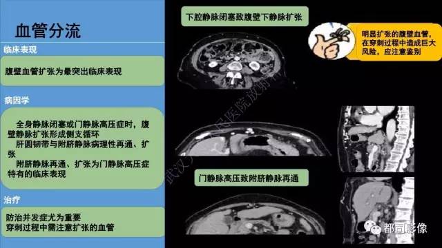 【PPT】腹壁病变-不只是腹壁疝