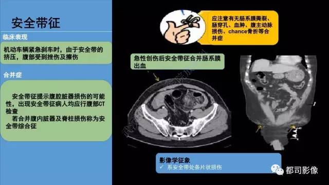 【PPT】腹壁病变-不只是腹壁疝