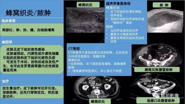 【PPT】腹壁病变-不只是腹壁疝