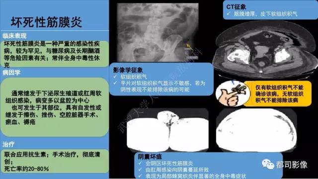 【PPT】腹壁病变-不只是腹壁疝