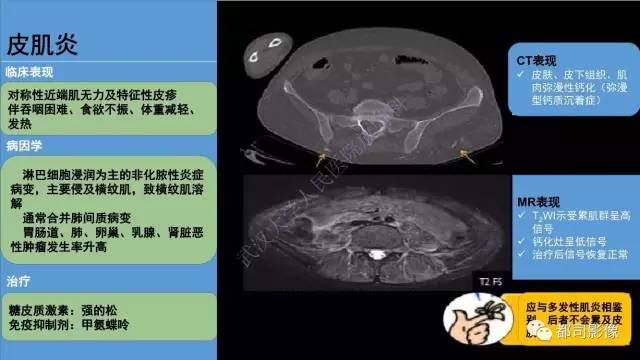 【PPT】腹壁病变-不只是腹壁疝