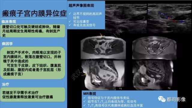 【PPT】腹壁病变-不只是腹壁疝