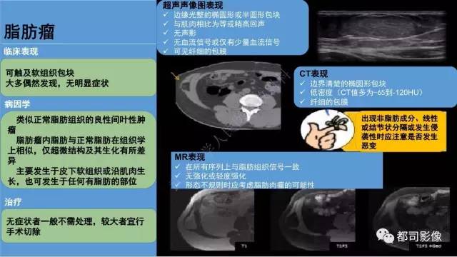 【PPT】腹壁病变-不只是腹壁疝