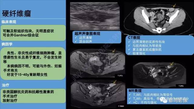 【PPT】腹壁病变-不只是腹壁疝