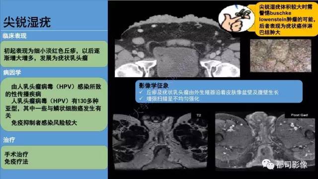 【PPT】腹壁病变-不只是腹壁疝