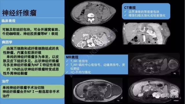 【PPT】腹壁病变-不只是腹壁疝