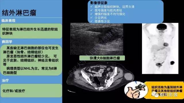 【PPT】腹壁病变-不只是腹壁疝