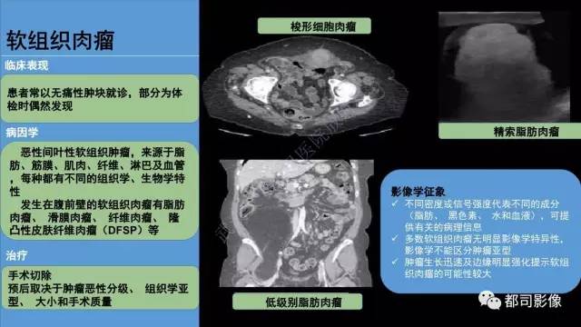 【PPT】腹壁病变-不只是腹壁疝