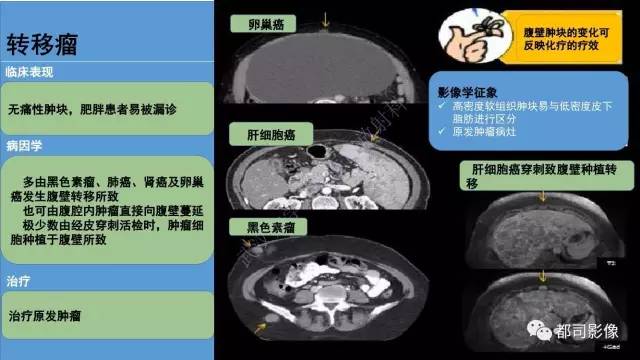 【PPT】腹壁病变-不只是腹壁疝