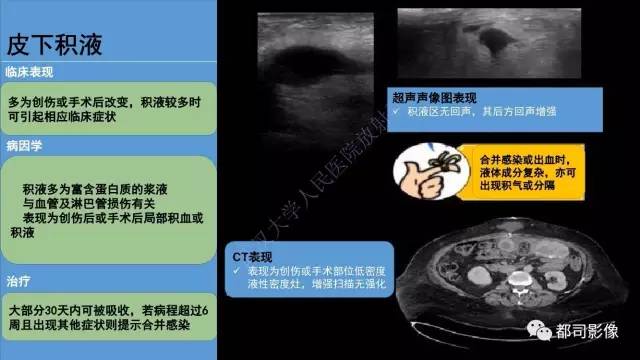 【PPT】腹壁病变-不只是腹壁疝