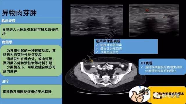 【PPT】腹壁病变-不只是腹壁疝