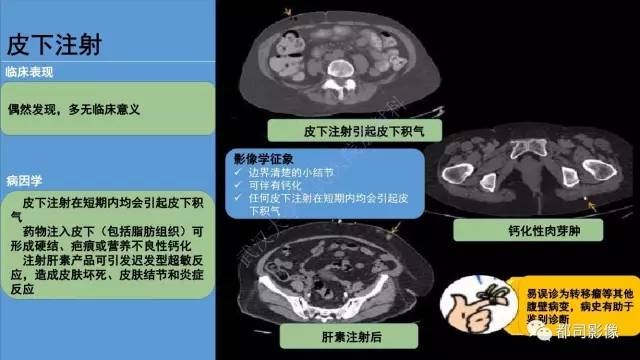 【PPT】腹壁病变-不只是腹壁疝