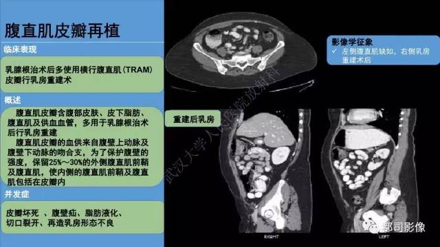【PPT】腹壁病变-不只是腹壁疝