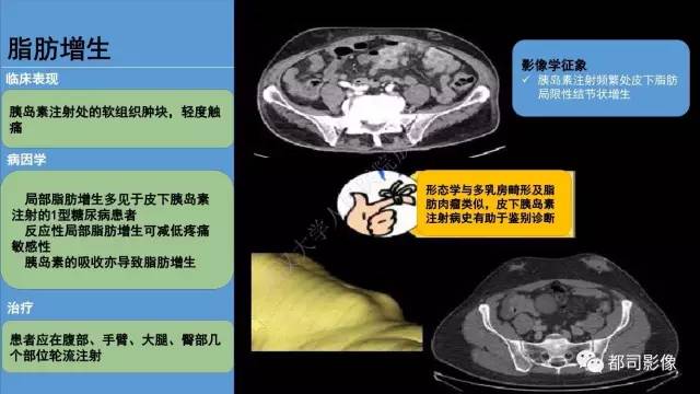 【PPT】腹壁病变-不只是腹壁疝