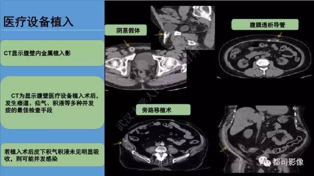 【PPT】腹壁病变-不只是腹壁疝
